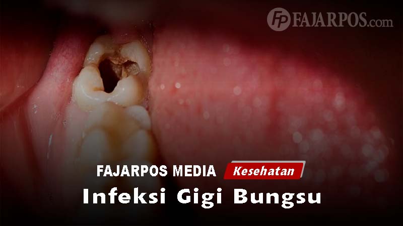 Ilustrasi Infeksi Gigi Bungsu
